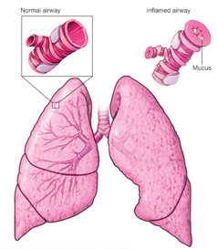 Best Asthma Specialist in Malad