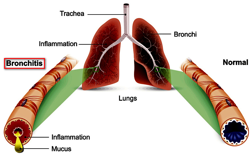 Best Bronchitis Specialist in Malad