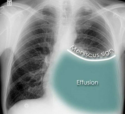 what causes non malignant pleural effusion